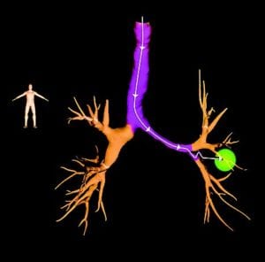 Nina Maouelainin, DO, demonstrates how the Electromagnetic Navigation Bronchoscope (left) can reach hard-to-access areas of the lung (above, right) and aid in the diagnosis and treatment of early stage lung diseases with greater effectiveness than ever before.