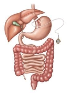 Laparoscopic Gastric Banding