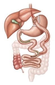 Roux-en-Y Gastric Bypass